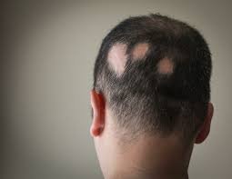 Promising Solution for Alopecia