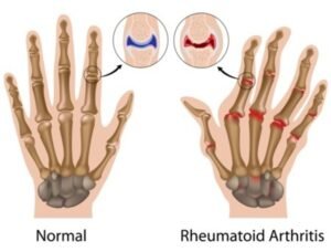 Rheumatoid Arthritis and solution